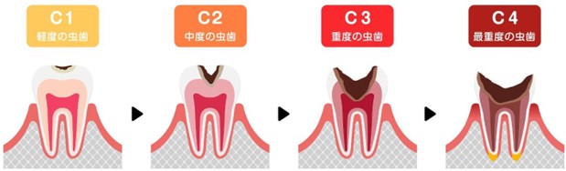むし歯の進行と治療法