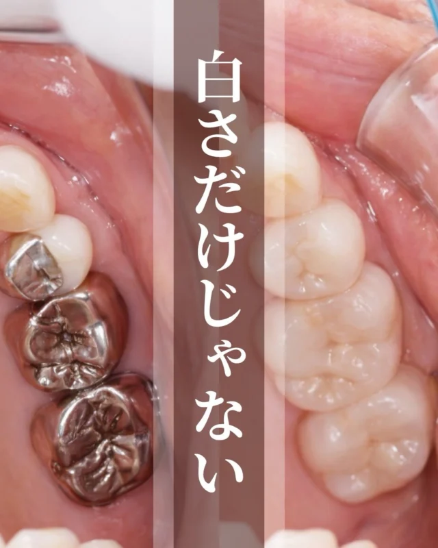 こんばんは🌇
苦楽園口いしみね歯科・小児歯科・矯正歯科です🦷

銀歯は、使っているうちにわずかに変形したり、接着剤が劣化したりすることがあります。
その影響で、見た目では気づきにくい小さなすき間が生まれ、そこから細菌が入り込みやすくなります。

銀歯の下で進行する虫歯は痛みが出にくく、発見が遅れてしまうことも少なくありません。
「問題なさそうに見える」のに、実は中で進んでいるケースもあります。

今回の症例では、銀歯をセラミックに置き換え、見た目だけでなく清掃のしやすさや噛み合わせまで丁寧に調整しました。
セラミックは長期間使っても形が安定しやすく、汚れや細菌が付着しにくい素材です。

ただ白くするための治療ではなく、
将来の安定や再発リスクまで考えた治療を大切にしています。

銀歯が気になっている方や、今入っている詰め物に不安がある方は、ぜひ一度ご相談ください。

✼••┈┈┈┈┈┈┈┈┈┈┈┈┈┈┈┈••✼
苦楽園口いしみね歯科・小児歯科・矯正歯科

📍苦楽園口駅徒歩1分
100台分の駐車スペースあり
〒662-0075 兵庫県西宮市南越木岩町10-7

⏰平日9:30から13:00/14:30から19:00
土日9:00から13:00/14:00から18:00
※木曜、祝日休診

🩺診察科目：一般歯科・小児歯科・矯正歯科・口腔外科
✼••┈┈┈┈┈┈┈┈┈┈┈┈┈┈┈┈••✼

#西宮矯正歯科 #西宮歯科 #苦楽園口 #夙川 #甲子園口
歯並び改善 歯並び気になる マウスピース矯正インビザライン
小児矯正 ワイヤー矯正 矯正相談 出っ歯 受け口 反対咬合
こども矯正 歯科矯正 矯正歯科 ホワイトニング西宮 西宮ママ 歯医者さん選び