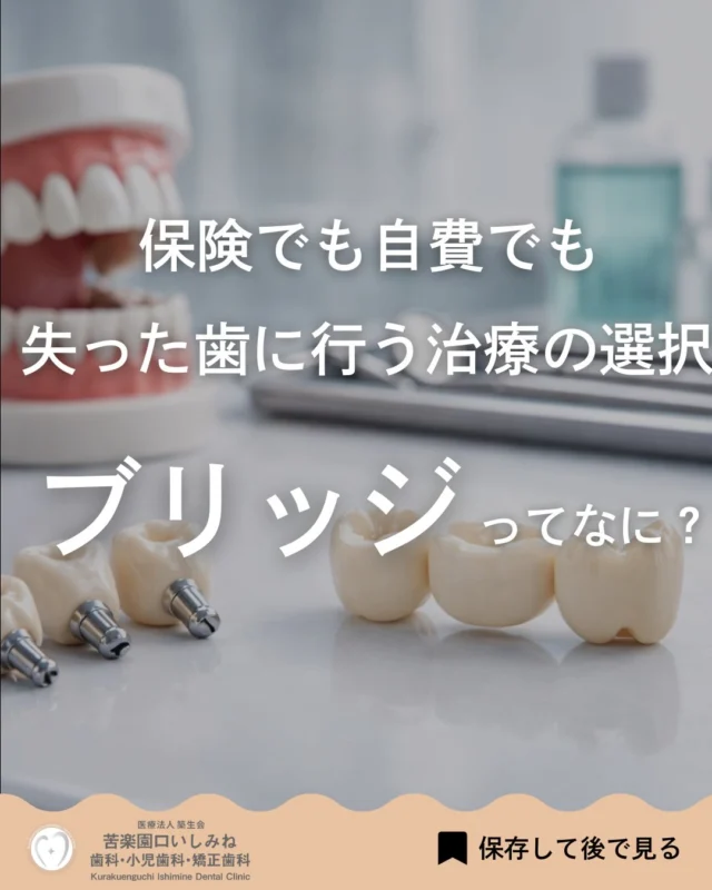 こんばんは🌇
苦楽園口いしみね歯科・小児歯科・矯正歯科です🦷

歯が1本なくなったとき そのままにしていませんか？🦷

前回は入れ歯とインプラントを比較しましたが 今回はもう一つの選択肢 「ブリッジ」について解説しています✨

ブリッジは 両隣の歯を支えにして 人工の歯を固定する治療です🦷

取り外しの必要がなく 比較的短期間で治療できるのが特徴ですが⏳
健康な歯を削る必要があるため、メリットだけでなく デメリットも理解して選ぶことが大切です⚠️

どの治療が良いかは お口の状態やライフスタイルによって異なります🪥

放置してしまうと 周りの歯が動いたり 噛み合わせが崩れることもあるため
気になる方は、早めのご相談をおすすめします💡

✼••┈┈┈┈┈┈┈┈┈┈┈┈┈┈┈┈••✼
苦楽園口いしみね歯科・小児歯科・矯正歯科

📍苦楽園口駅徒歩1分
100台分の駐車スペースあり
〒662-0075 兵庫県西宮市南越木岩町10-7

⏰平日9:30から13:00/14:30から19:00
土日9:00から13:00/14:00から18:00
※木曜、祝日休診

🩺診察科目：一般歯科・小児歯科・矯正歯科・口腔外科
✼••┈┈┈┈┈┈┈┈┈┈┈┈┈┈┈┈••✼

#西宮矯正歯科 #西宮歯科 #苦楽園口 #夙川 #芦屋　西宮北口
ブリッジ治療 歯がない 歯科治療 インプラント 入れ歯
歯並び改善 歯並び気になる マウスピース矯正インビザライン
小児矯正 ワイヤー矯正 矯正相談 出っ歯 受け口 反対咬合
こども矯正 歯科矯正 矯正歯科 ホワイトニング西宮 西宮ママ 歯医者さん選び