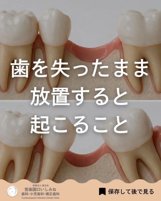 こんばんは🌇
苦楽園口いしみね歯科・小児歯科・矯正歯科です🦷

歯を1本失ったまま、放置していませんか？💁🏼

見た目は大きく変わらなくても、 お口の中では少しずつ変化が起こることがあります。
隣の歯が傾く、 噛み合う歯が伸びる、 噛み合わせがズレるなど、 1本の欠損が全体のバランスに影響することもあります。

その結果、 汚れがたまりやすくなったり、 他の歯に負担がかかったりすることがあります😿

放置期間が長くなるほど、 治療の選択肢が限られる場合もあります。
今すぐ症状がなくても、 気になる段階で確認しておくことが大切です。
まずは現在の状態チェックから、お気軽にご相談ください📩

✼••┈┈┈┈┈┈┈┈┈┈┈┈┈┈┈┈••✼
苦楽園口いしみね歯科・小児歯科・矯正歯科

🔍HP: kurakuenguchi-ishiminedental.comhttps://kurakuenguchi-ishiminedental.com

📍苦楽園口駅徒歩1分
100台分の駐車スペースあり
〒662-0075 兵庫県西宮市南越木岩町10-7

⏰平日9:30から13:00/14:30から19:00
土日9:00から13:00/14:00から18:00
※木曜、祝日休診

🩺診察科目：一般歯科・小児歯科・矯正歯科・口腔外科
✼••┈┈┈┈┈┈┈┈┈┈┈┈┈┈┈┈••✼

#西宮矯正歯科 西宮歯科 #苦楽園口 #夙川 西宮北口 芦屋
歯並び改善 歯並び気になる マウスピース矯正インビザライン
小児矯正 ワイヤー矯正 矯正相談 出っ歯 受け口 反対咬合#インプラント#ブリッジ
こども矯正 歯科矯正 矯正歯科 ホワイトニング西宮 西宮ママ 歯医者さん選び