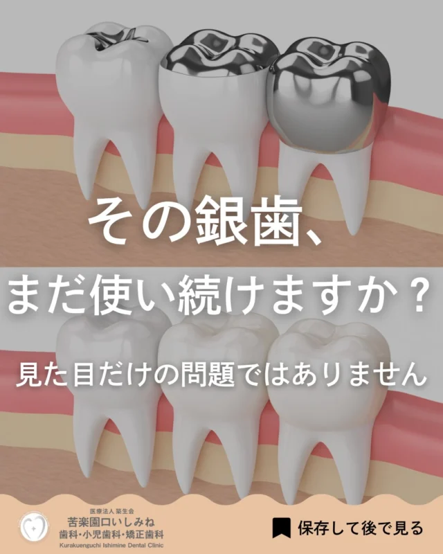 こんばんは🌇
苦楽園口いしみね歯科・小児歯科・矯正歯科です🦷

銀歯、そのままにしていませんか？🦷
「昔入れたから問題ない」 そう思っている方も多いですが、 銀歯は時間とともに わずかな変形やズレが起こることがあります⚠️

その隙間から細菌が入り、 中で虫歯が進行してしまうことも。
「痛くない＝問題ない」ではありません。

再治療になると、 削る量や負担が増えるケースもあります。

最近では セラミックなど自然で精度の高い素材や✨ 保険で選べる白い歯もあります。

まずは今の状態をチェックしてみませんか？🔍 気になる方はお気軽にご相談ください😊

✼••┈┈┈┈┈┈┈┈┈┈┈┈┈┈┈┈••✼
苦楽園口いしみね歯科・小児歯科・矯正歯科

HP🔍: https://kurakuenguchi-ishiminedental.com/

📍苦楽園口駅徒歩1分
100台分の駐車スペースあり
〒662-0075 兵庫県西宮市南越木岩町10-7

⏰平日9:30から13:00/14:30から19:00
土日9:00から13:00/14:00から18:00
※木曜、祝日休診

🩺診察科目：一般歯科・小児歯科・矯正歯科・口腔外科
✼••┈┈┈┈┈┈┈┈┈┈┈┈┈┈┈┈••✼

#西宮矯正歯科#苦楽園口 #夙川
#銀歯を白い歯 #セラミック症例
マウスピース矯正　インビザライン
小児矯正 ワイヤー矯正 矯正相談 出っ歯 受け口 反対咬合
こども矯正 歯科矯正 矯正歯科 ホワイトニング西宮 西宮ママ 歯医者さん選び