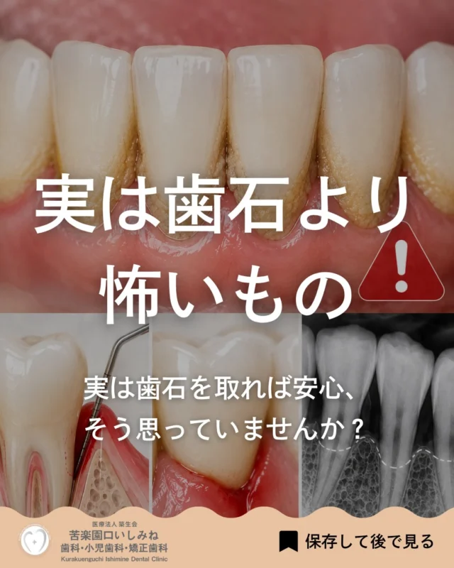 こんばんは🌇
苦楽園口いしみね歯科・小児歯科・矯正歯科です🦷

最近、「歯石は取っているから大丈夫」と思っていませんか？
実は、歯石そのものよりも注意したいのが歯周病です。
歯周病は初期の段階ではほとんど自覚症状がなく、
気づかないうちに進行してしまうことがあります。

✔ 歯ぐきから血が出る ✔ 歯周ポケットが深い ✔ 口臭が気になる ✔ 歯が少しグラつく気がする

このような症状は、歯周病のサインかもしれません。
特に歯を支える骨は、一度失われると元には戻りません。
だからこそ大切なのは、歯石を取ることだけではなく、
お口全体の状態を定期的にチェックすることです。

当院では歯周ポケットの測定やレントゲン検査を行い、
お口の状態を総合的に確認しています。

「痛みはないけど気になる」 「しばらく歯医者に行っていない」
そんな方もお気軽にご相談ください🦷✨

✼••┈┈┈┈┈┈┈┈┈┈┈┈┈┈┈┈••✼
苦楽園口いしみね歯科・小児歯科・矯正歯科

HP🔍: https://kurakuenguchi-ishiminedental.com/

📍苦楽園口駅徒歩1分
100台分の駐車スペースあり
〒662-0075 兵庫県西宮市南越木岩町10-7

⏰平日9:30から13:00/14:30から19:00
土日9:00から13:00/14:00から18:00
※木曜、祝日休診

🩺診察科目：一般歯科・小児歯科・矯正歯科・口腔外科
✼••┈┈┈┈┈┈┈┈┈┈┈┈┈┈┈┈••✼

西宮矯正歯科 #西宮歯科 #苦楽園口 
 #歯周病 #歯石取り #定期検診
