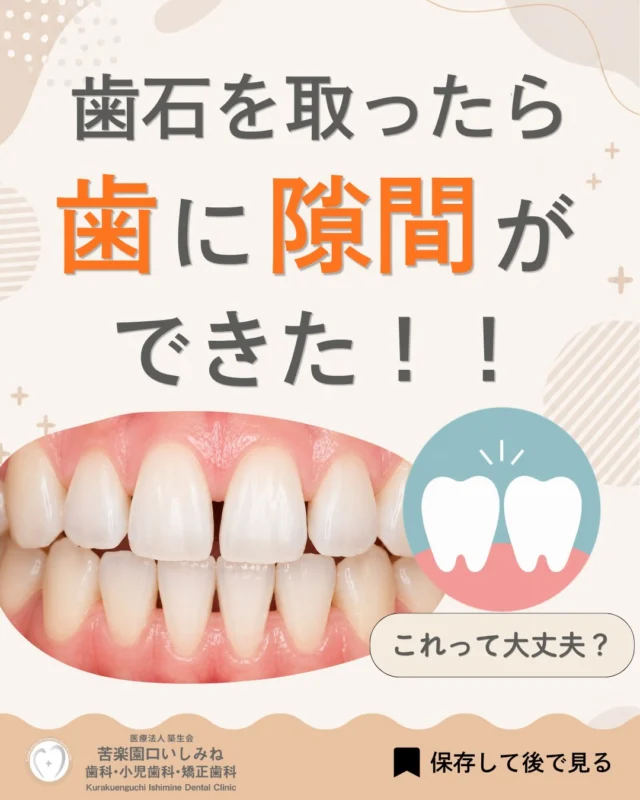 こんばんは🌙
苦楽園口いしみね歯科・小児歯科・矯正歯科です🦷

「歯石を取ったら歯に隙間ができた…😳」
クリーニング後に鏡を見て、 「前より歯と歯の間が広がった気がする…」 「歯が長く見えるようになった…」 と驚いたことはありませんか？👀

実は、その変化は悪くなったサインではないことがあります✨
歯石が歯と歯の間を埋めていた場合、
歯石を取り除くことで本来あった隙間が見えるようになります🦷

また、炎症で腫れていた歯ぐきが健康な状態へ戻ることで、
歯が長く見えたり、隙間が目立ったりすることもあります🌿

つまり、「隙間ができた」のではなく、
もともとあった状態に戻ったというケースが多いのです😊

もちろん、お口の状態によって原因はさまざまです💡 気になる症状がある場合は、
そのままにせず歯科医院で確認してもらいましょう。

歯石を取った後は、
見えるようになった隙間に汚れが残りやすくなることがあります🪥

歯ブラシだけでなく、フロスや歯間ブラシも取り入れながら、
毎日のケアを続けることが大切です✨

「歯石を取ったら隙間ができたから失敗したのかな…😢」 と不安に思っている方は、ぜひ最後まで投稿をご覧ください📖
ご不安なことや気になる症状があれば、お気軽にご相談ください😊🦷

✼••┈┈┈┈┈┈┈┈┈┈┈┈┈┈┈┈••✼
苦楽園口いしみね歯科・小児歯科・矯正歯科

HP🔍: https://kurakuenguchi-ishiminedental.com/

📍苦楽園口駅徒歩1分
100台分の駐車スペースあり
〒662-0075 兵庫県西宮市南越木岩町10-7

⏰平日9:30から13:00/14:30から19:00
土日9:00から13:00/14:00から18:00
※木曜、祝日休診

🩺診察科目：一般歯科・小児歯科・矯正歯科・口腔外科
✼••┈┈┈┈┈┈┈┈┈┈┈┈┈┈┈┈••✼

#苦楽園口いしみね歯科 #西宮歯医者 #歯石除去 #クリーニング #歯周病